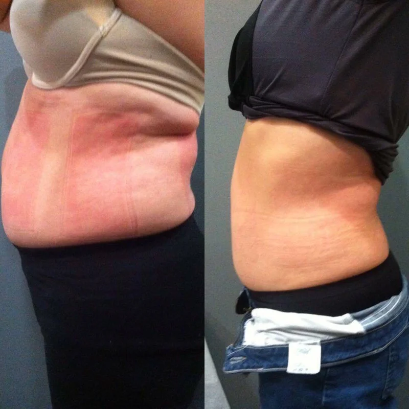 Before and after body contouring results at Define Body Contouring by Sloane